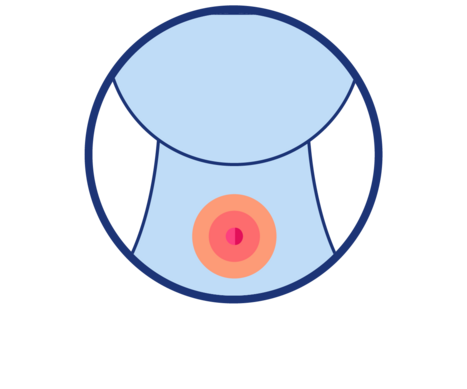 Icon zur Darstellung von intensiven Halsbeschwerden