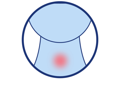 Icon zur Darstellung von leichten Halsbeschwerden